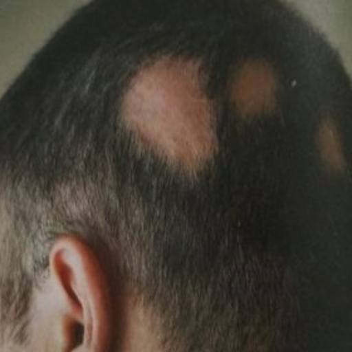 Tratamento para Alopecia Areata por Espaço Ka Terapia Capilar e Estética