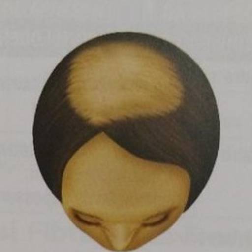 Tratamento para Alopecia Feminina