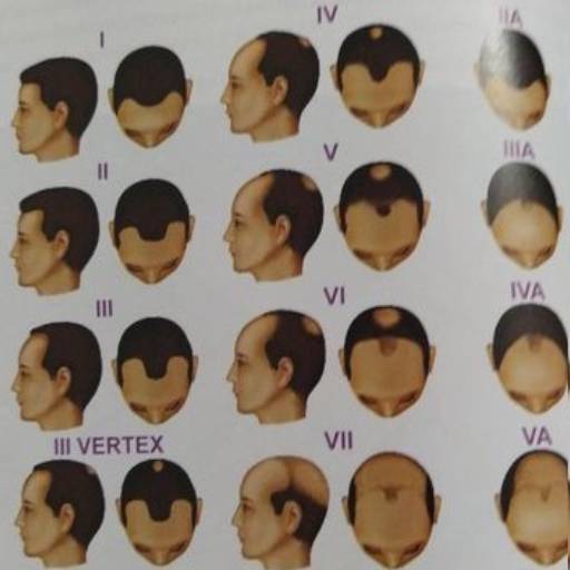 Tratamento para Alopecia Masculina
