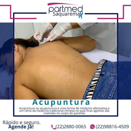 Comprar o produto de Acupuntura  em Acupuntura pela empresa Partmed Saúde e Medicina em Saquarema, RJ por Solutudo