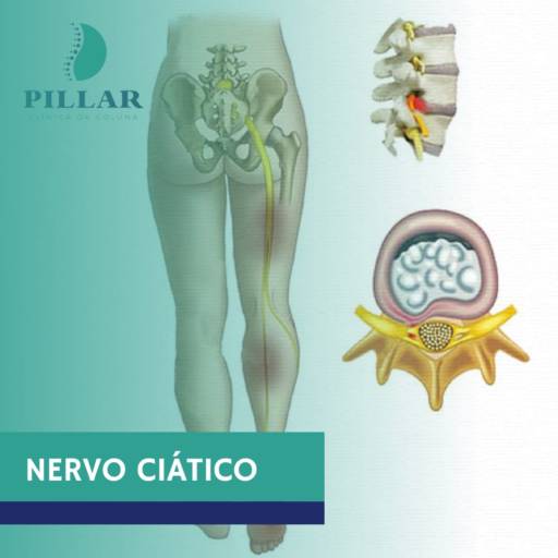 Comprar o produto de NERVO CIÁTICO  em Fisioterapia pela empresa Pillar - Clinica da Coluna em Botucatu, SP por Solutudo
