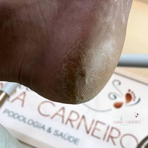 Rachadura nos pés  por Luara Carneiro podologia e saúde