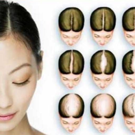 Alopecia Androgenética