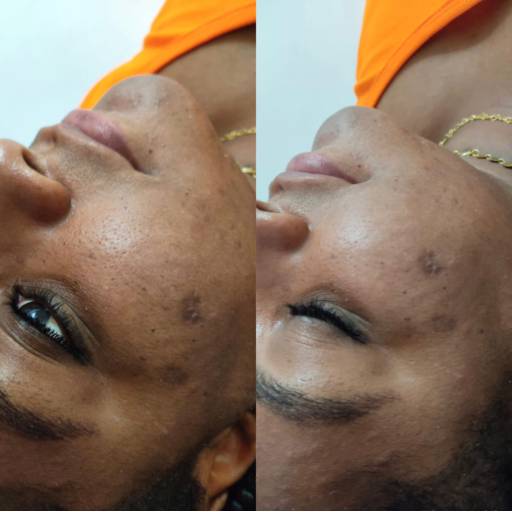Peeling químico