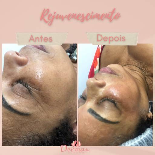 Rejuvenescimento