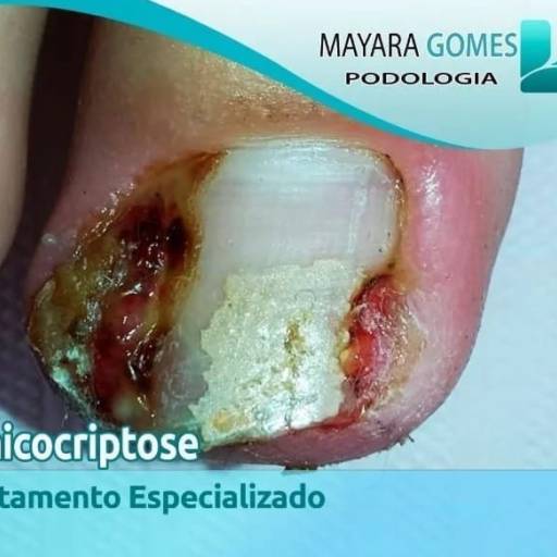 Tratamento de Onicocriptose (Unha Encravada) por Mayara Gomes Podologia