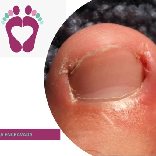 UNHA ENCRAVADA  por Raquel - Podologia