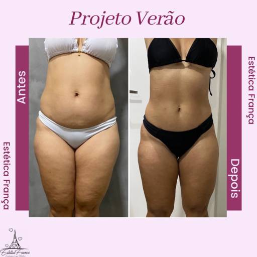 Drenagem Linfática por Estética França