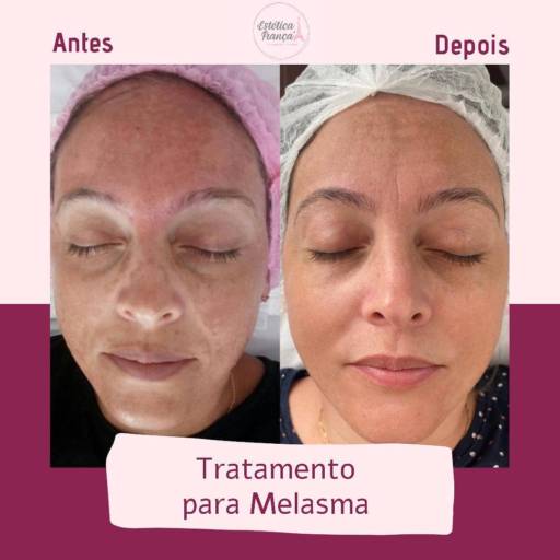 Tratamento para Melasma por Estética França