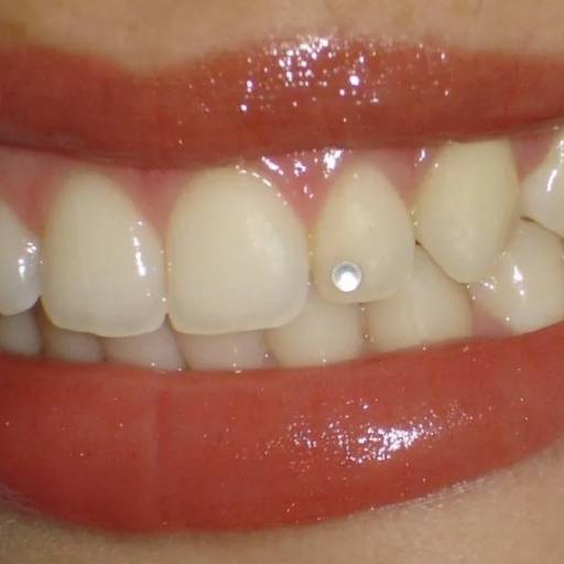 Venha colocar o seu Piercing Dental em Bauru por Lopes Saúde e Odontologia