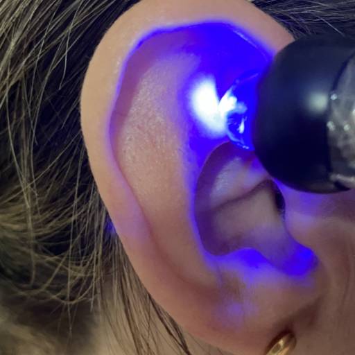 Acupuntura Auricular em Jaú, SP por Lucas Mageste Acupuntura