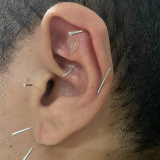 Acupuntura Auricular em Jaú, SP por Lucas Mageste Acupuntura