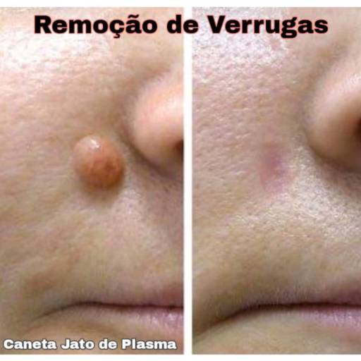 Remoção de verrugas por Belas Amoras Esteticista