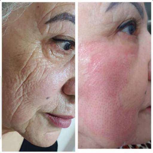 Rejuvenescimento Facial por Belas Amoras Esteticista