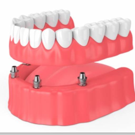 Comprar o produto de Prótese Carga Imediata em Odontologia pela empresa Sorrix Odontologia  em Avaré, SP por Solutudo