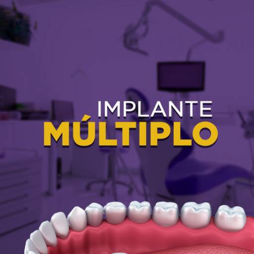 Implante Múltiplo por Sorrix Odontologia 