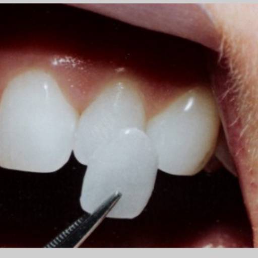 Facetas (lentes) por Sorrix Odontologia 