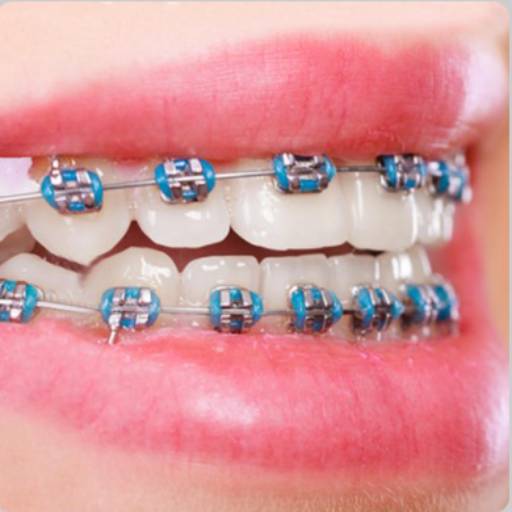 Aparelho Auto Ligado Estético por Sorrix Odontologia 