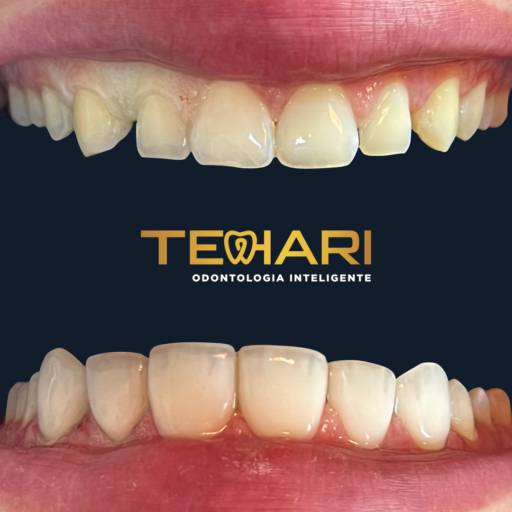 Comprar o produto de Lentes em Resina Composta em Odontologia pela empresa Tehari Odontologia Inteligente em Osasco, SP por Solutudo