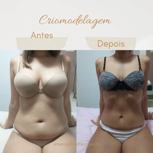 Criomodelagem em Bauru por Fisioterapeuta Márcia Gasparini