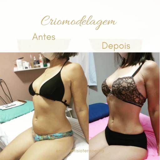 Criomodelagem em Bauru por Fisioterapeuta Márcia Gasparini