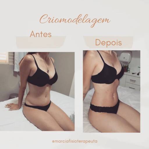 Criomodelagem em Bauru por Fisioterapeuta Márcia Gasparini