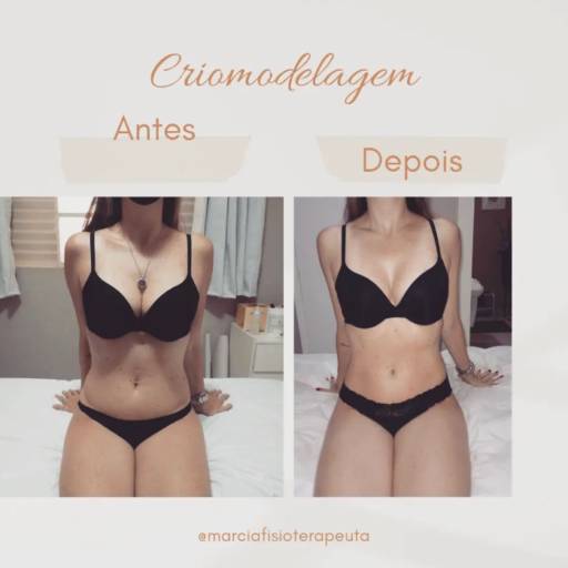 Criomodelagem em Bauru por Fisioterapeuta Márcia Gasparini
