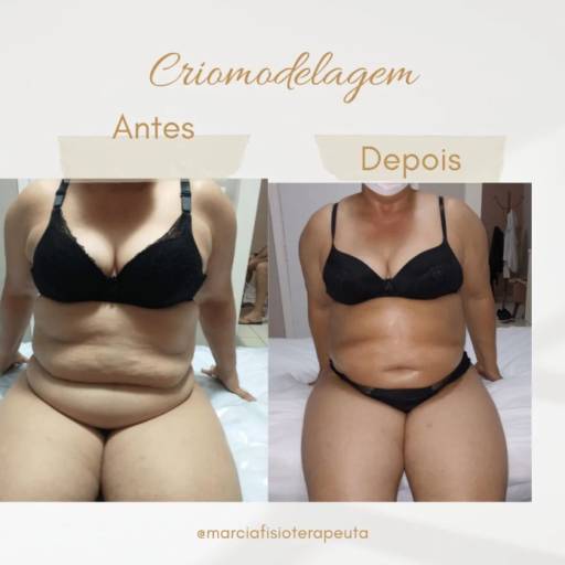 Criomodelagem em Bauru por Fisioterapeuta Márcia Gasparini