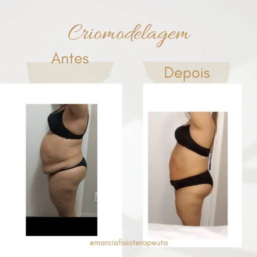 Criomodelagem em Bauru por Fisioterapeuta Márcia Gasparini