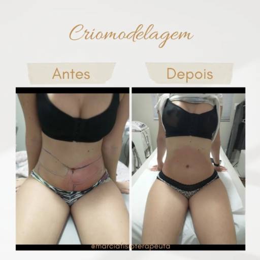 Criomodelagem em Bauru por Fisioterapeuta Márcia Gasparini