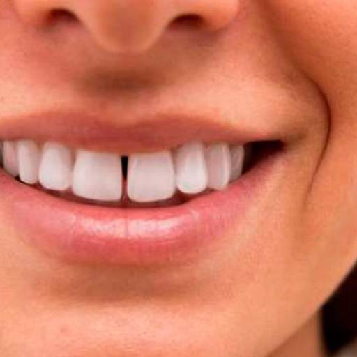 Tratamento de Diastema por Tehari Odontologia Inteligente