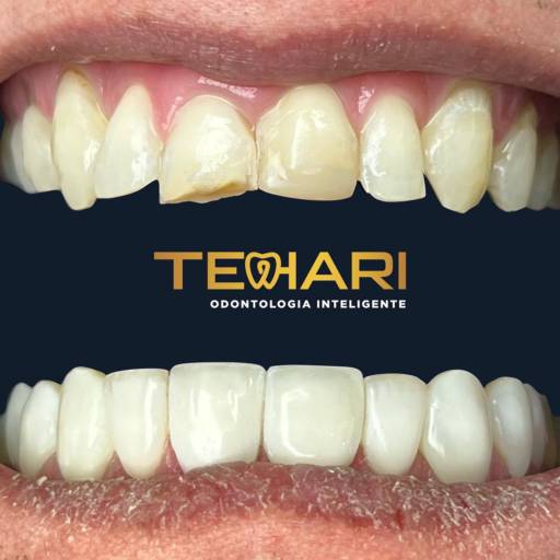 Implante Unitário por Tehari Odontologia Inteligente