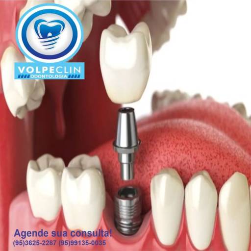 Implantes dentais por Volpeclin Odontologia