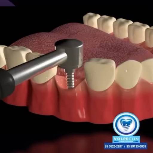 Tratamento de canal por Volpeclin Odontologia