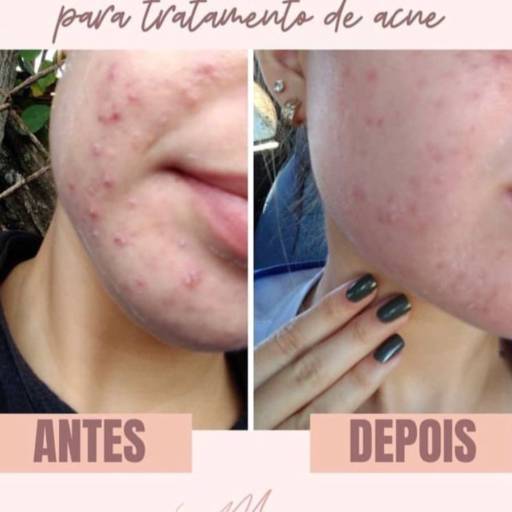 Tratamento de acne