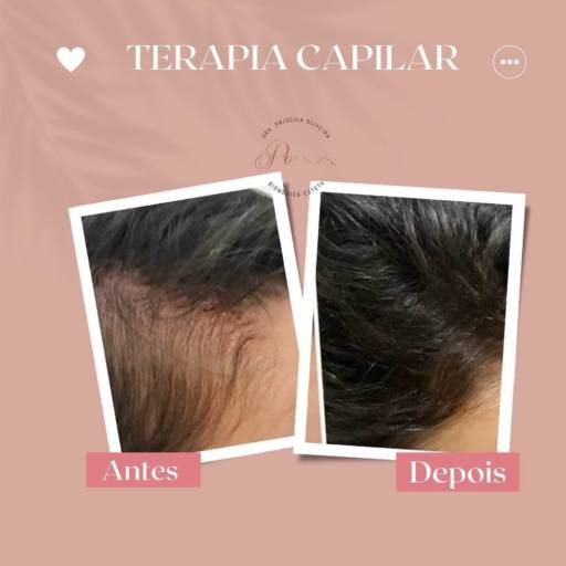 Terapia capilar