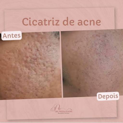 Tratamento de acne