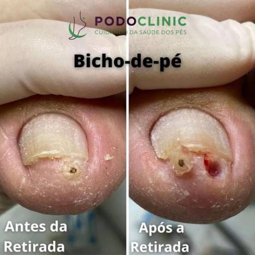 Comprar o produto de Remoção de Bicho de pé em Podologia pela empresa PodoClinic Clínica de Podologia em Itaitinga, CE por Solutudo