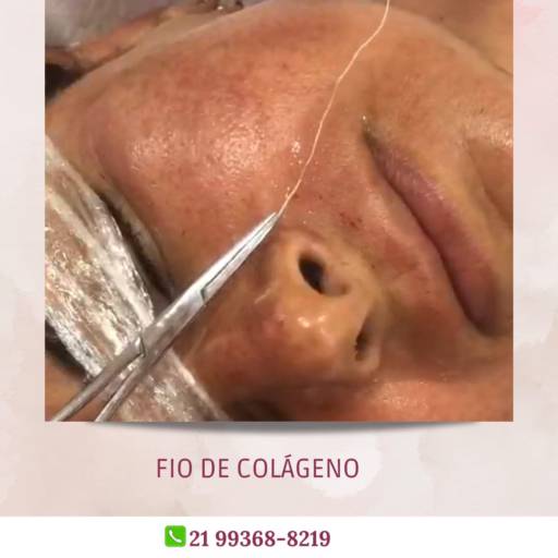  Fio de Colágeno: Rejuvenesça Sua Pele no Rio de Janeiro/RJ por Encanto Estética