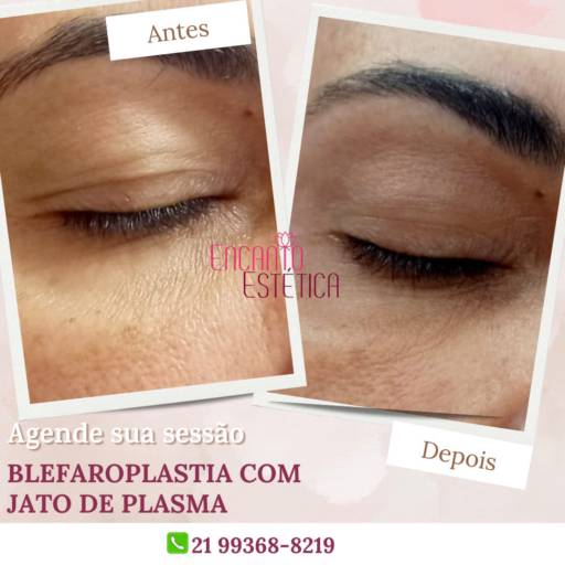 Blefaroplastia: Rejuvenesça Seu Olhar no Rio de Janeiro/RJ por Encanto Estética