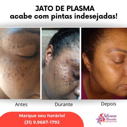 Remoção de pintas por Silvana Almeida estética