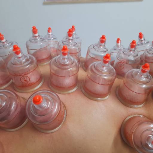 Ventosaterapia por Jean Michel - Liberação Miofascial