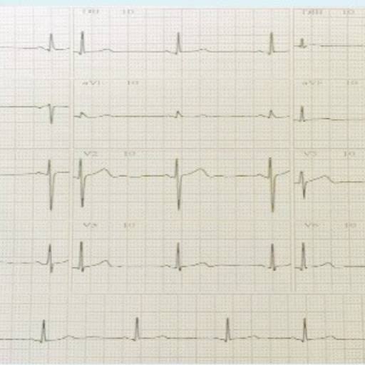 Eletrocardiograma (EGC) por Cardioss Clínica Cardiológica