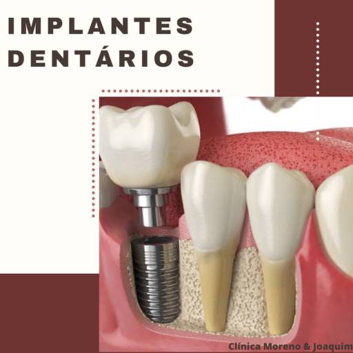 Comprar o produto de Implantes Dentários em Odontologia pela empresa Clinica Moreno & Joaquim em Botucatu, SP por Solutudo