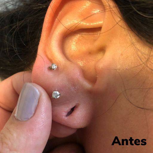 Lobuloplastia não cirúrgica em Guarulhos  por Meu Primeiro Brinco - Furo Humanizado