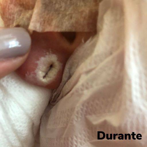 Lobuloplastia não cirúrgica em Guarulhos  por Meu Primeiro Brinco - Furo Humanizado