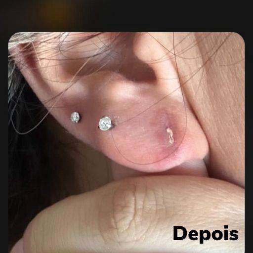 Lobuloplastia não cirúrgica em Guarulhos  por Meu Primeiro Brinco - Furo Humanizado