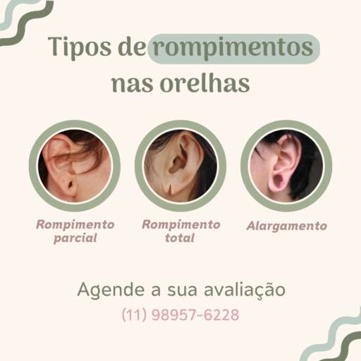 Lobuloplastia não cirúrgica em Guarulhos  por Meu Primeiro Brinco - Furo Humanizado