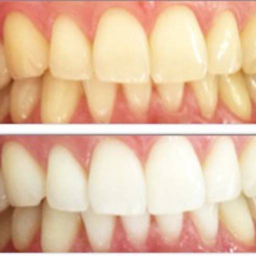 Clareamento Dental em Resende, RJ por Clínica Torquato