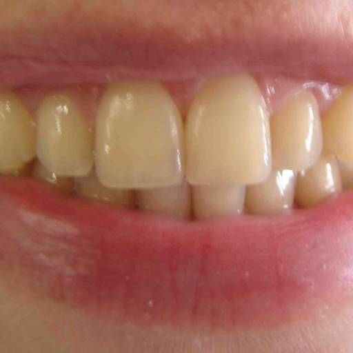 Clareamento Dental em Resende, RJ por Clínica Torquato